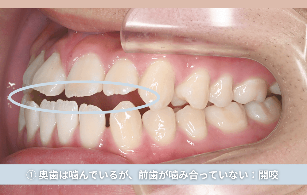 ① 奥歯は噛んでいるが、前歯が噛み合っていない:開咬