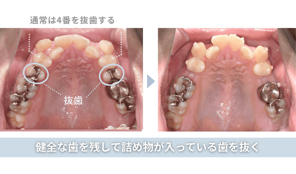 健全な歯を残して詰め物が入っている歯を抜く