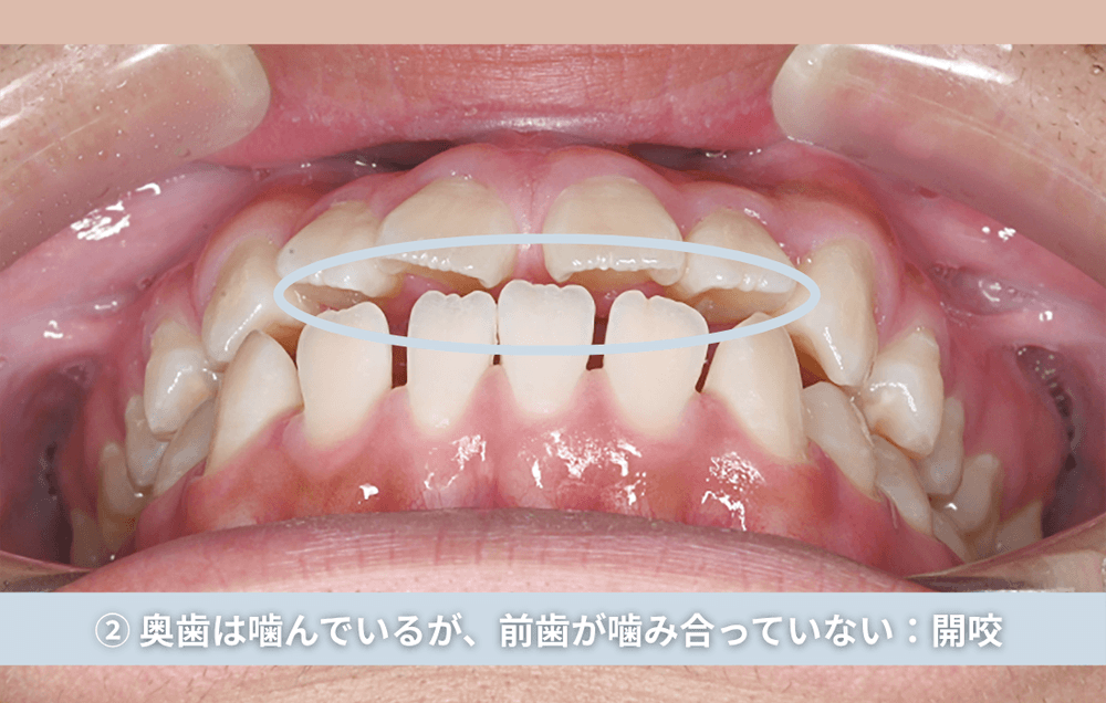 ② 奥歯は噛んでいるが、前歯が噛み合っていない:開咬