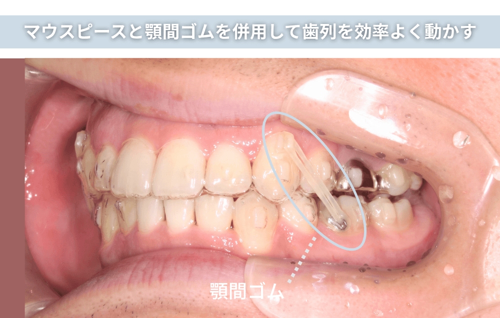 マウスピースと顎間ゴムを併用して歯列を効率よく動かす