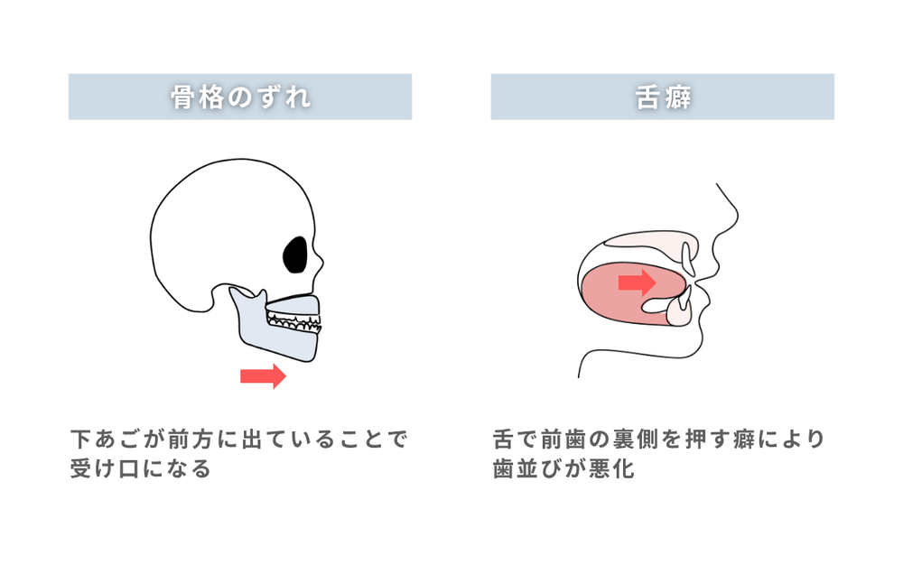骨格的な要因と舌癖