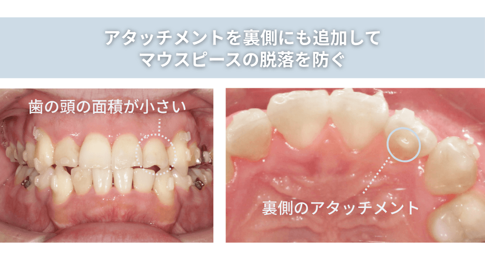 アタッチメントを裏側にも追加してマウスピースの脱落を防ぐ