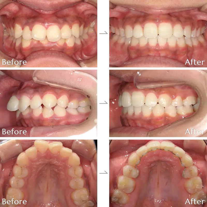 出っ歯(上顎前突)矯正の症例