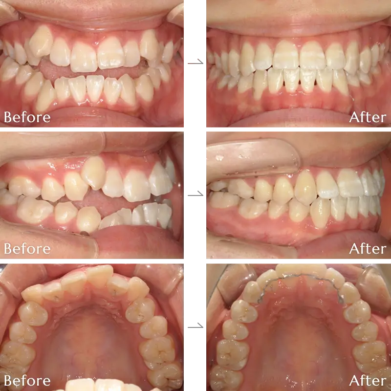 受け口（下顎前突）の矯正