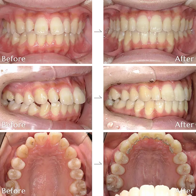 すきっ歯（空隙歯列）矯正の症例