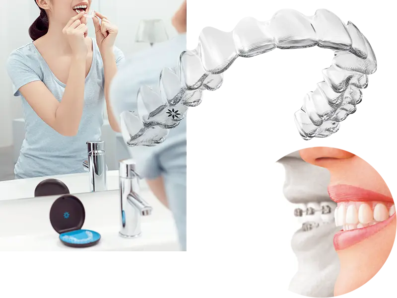 マウスピース矯正