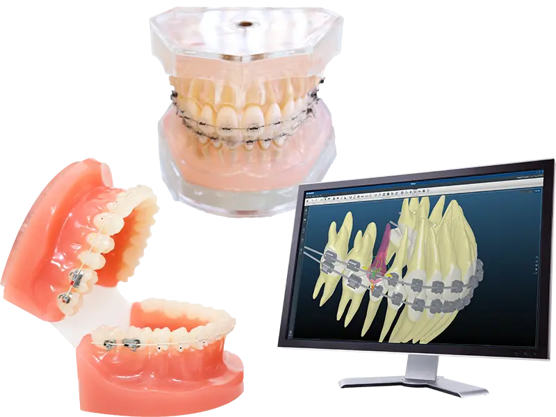 表側矯正（ワイヤー矯正）
