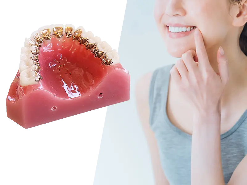 舌側矯正（ワイヤー矯正）