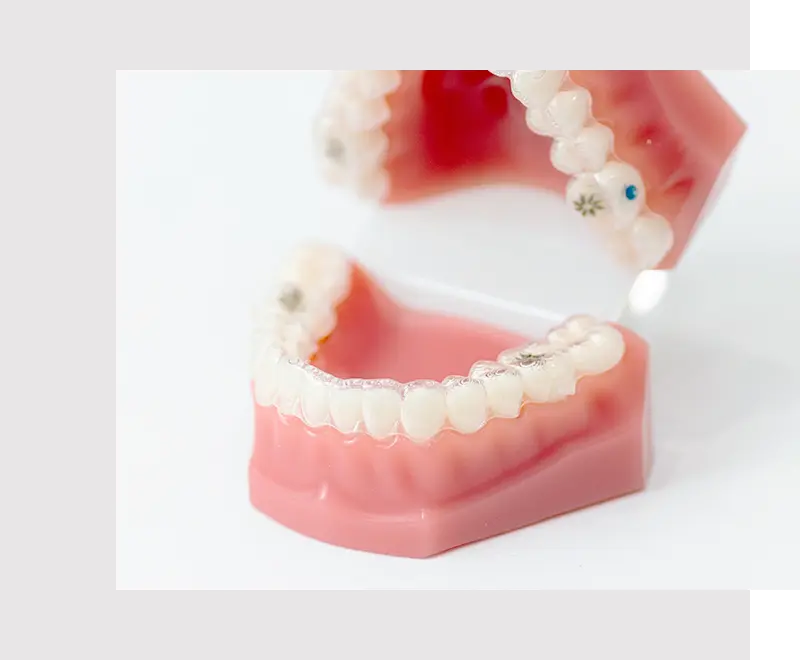 審美的な矯正装置