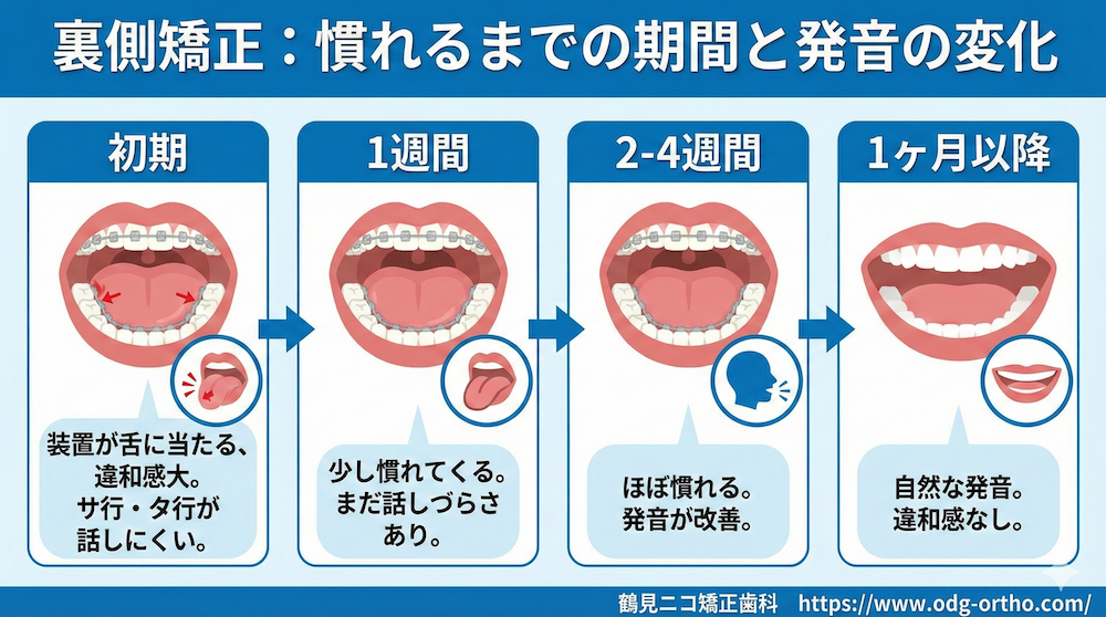 裏側矯正に慣れるまでの期間と発音の変化