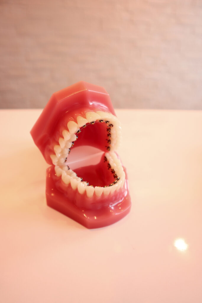 裏側矯正：歯の裏側に装置がついている