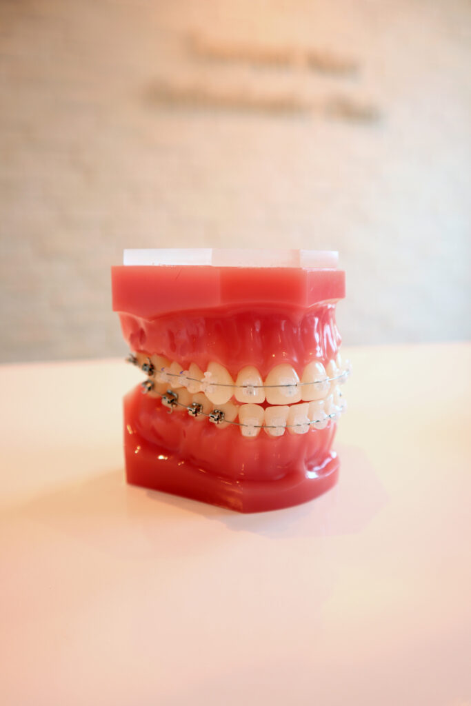 表側矯正：歯の表側に装置がついている