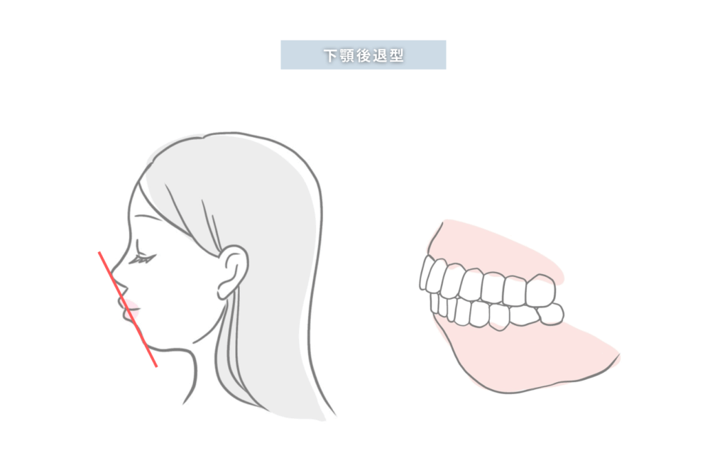 下顎後退型
