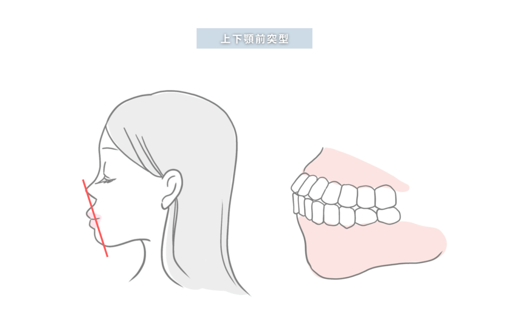上下顎前突型