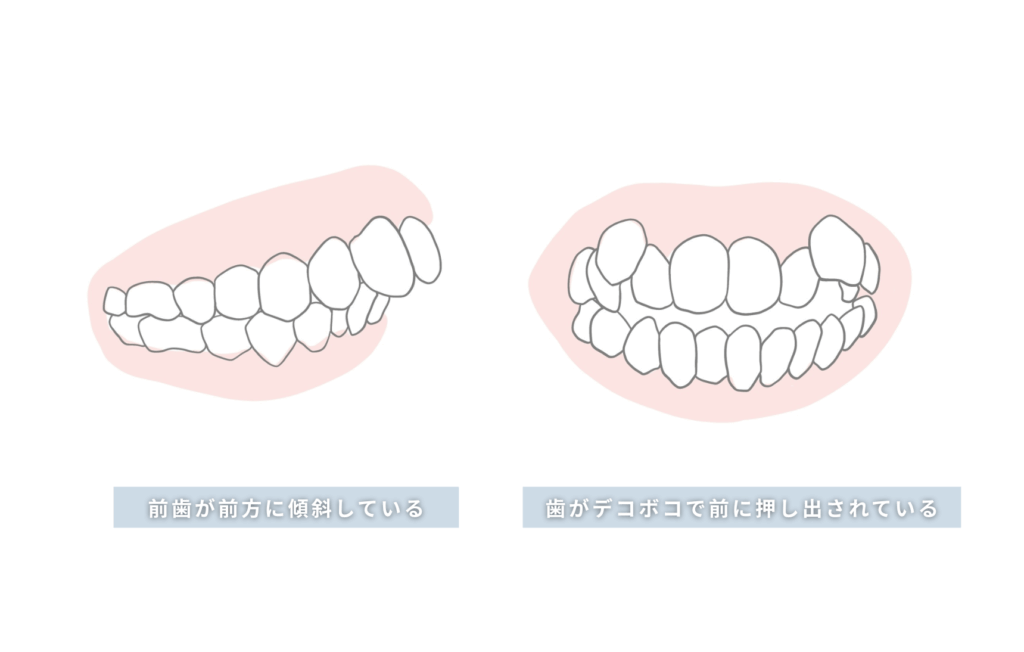 前歯が前方に傾斜している/歯がデコボコで前に押し出されている