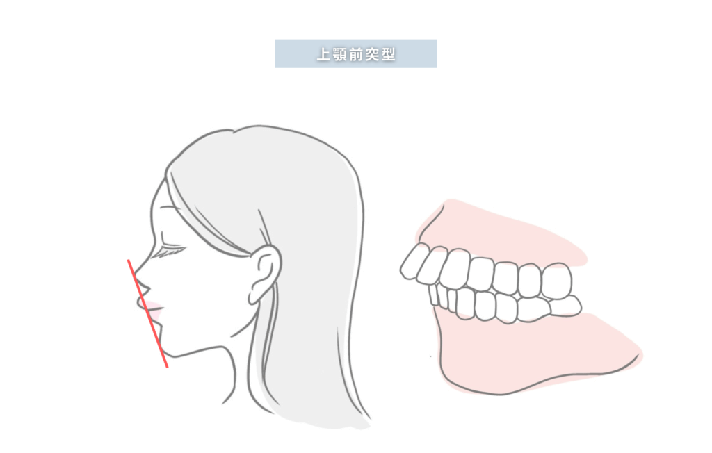 上顎前突型