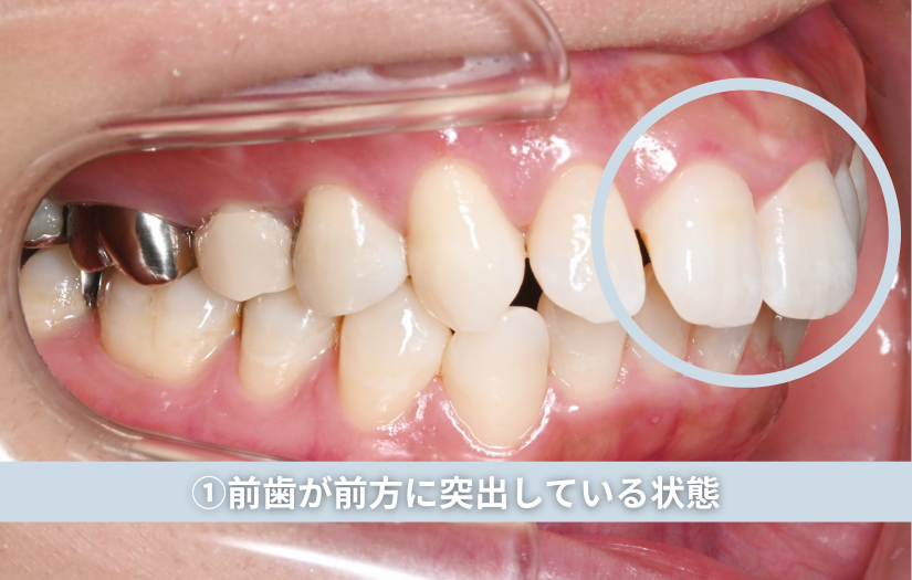 前歯が前方に突出している状態