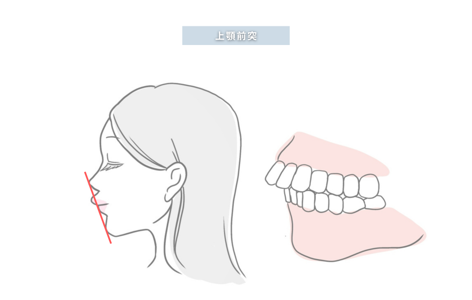 上顎前突イメージ
