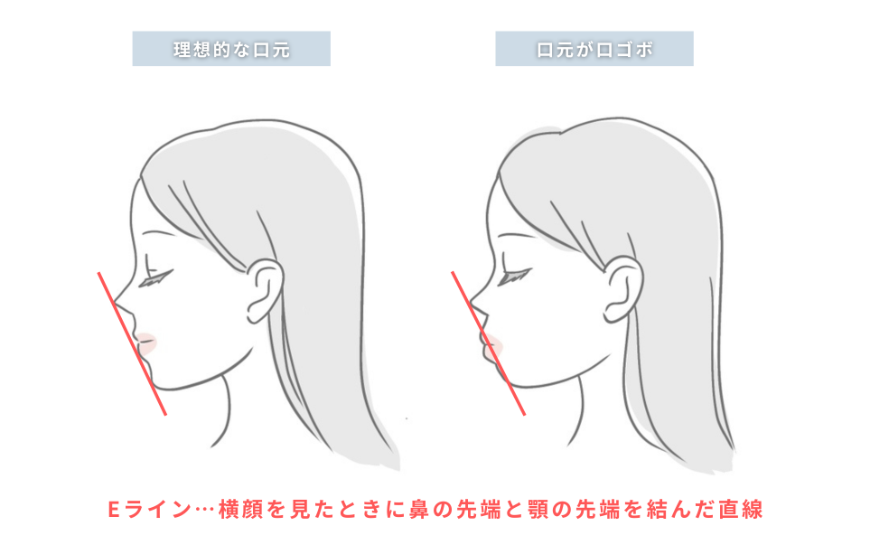 理想的な口元と口ゴボの口元の比較イメージ
※Eライン…横顔を見たときに鼻の先端と顎の先端を結んだ直線
